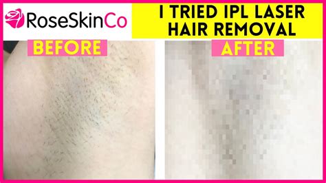 brazilian laser hair removal progress photos